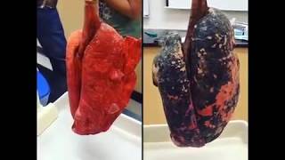 Smokers Lungs VS Nonsmokers Lungs [upl. by Pillihp246]