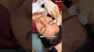 Face PRP Treatment acnescars skincare [upl. by Clarine]