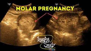 Molar Pregnancy  Hydatidiform Mole  Gestational Trophoblastic Disease  Ultrasound  Case 38 [upl. by Abehsat]