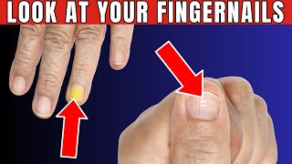 Fingernails Warning You 7 Signs You Have Health Problems [upl. by Ydeh207]