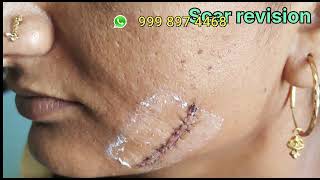 stitches scar plastic surgery in vadodara  Remove Stitch  stitches scar laser treatment [upl. by Mavilia]