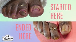 Rams Horn Toenail Where she started and where she is now [upl. by Deeanne]