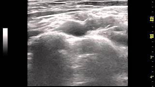 MSKUS Scan of Long Axis of Omohyoid Muscle by Dr Stanley Lam [upl. by Nerag]