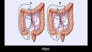 Surgery Treatment Options for Colorectal Cancer  Memorial Sloan Kettering [upl. by Allemac564]