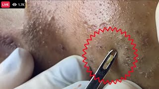 Cystic Acne pimples amp Blackheads Extraction On face Acne Treatment part  Most satisfying face HD [upl. by Alram393]