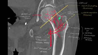 Know your hip fractures and the importance of arterial anatomy of the proximal femur [upl. by Asilef736]