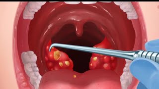 This is how tonsil stones are removed and tooth implant [upl. by Trometer946]