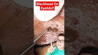 No Way  CRAZY BLACKHEAD REMOVAL On Eyelid shorts [upl. by Eatnad]