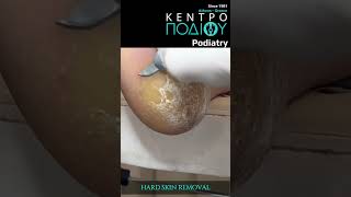 Hard Skin Removal calluses footpain κεντροποδιου feet foot πόδια callusremoval footcare [upl. by Grane562]