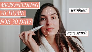 I Tried Microneedling at Home for 30 days before amp after  Deminuage Review [upl. by Sabrina]