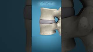 What is Lumbar Disc Herniation Shorts Atlantic Spine Center [upl. by Dyolf440]