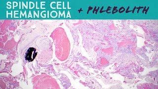 Spindle cell hemangioma with phlebolith arising in a vascular malformation pathology dermpath [upl. by Loginov]