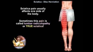 Low back pain Sciatica Disc Herniation  Everything You Need To Know  Dr Nabil Ebraheim [upl. by Hayifas]