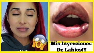 INYECCIONES DE LABIOS CON ACIDO HIALURONICO JUVEDERM LIP INJECCIONS [upl. by Amehr]