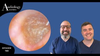 EPIC SKIN PEEL amp IMPACTED EAR WAX REMOVAL  EP789 [upl. by Ehtyde]