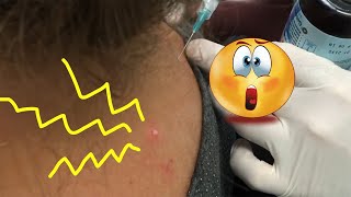 Neck Quickie Trigger Point Injections [upl. by Aker605]