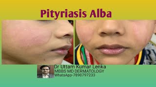 What is Pityriasis alba चेहरे में सदा दाग का इलाज  white spots on face  dr uttam lenka [upl. by Annais554]