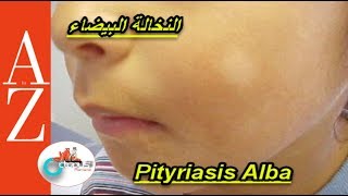 Pityriasis alba  From A to Z  النخالة البيضاء  اسبابها  أعراضها  طرق العلاج والوقاية [upl. by Morissa]