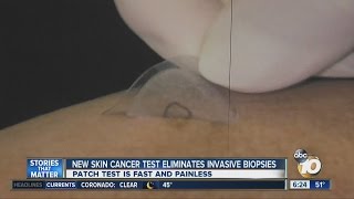 New skin cancer patch test eliminates invasive biopsies [upl. by Ysset]