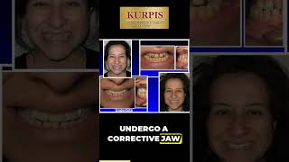 Underbite Correction Without Jaw Surgery [upl. by Nairda360]