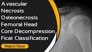 Avascular Necrosis  Osteonecrosis  Femoral Head  Core Decompression  Ficat Classification [upl. by Haslett592]