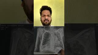 Pneumothorax hospital shortsvideo viralvideo [upl. by Okir]