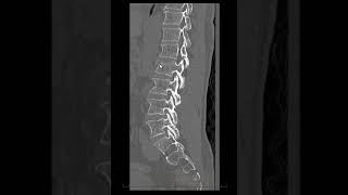 Fratura de corpos vertebrais com hematoma epidural anterior [upl. by Ajssatan]