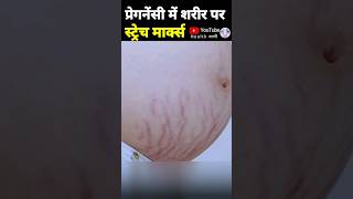 प्रेगनेंसी में स्ट्रेच मार्क्स को कैसे रोकें pregnancystretchmarks striae stretchmark [upl. by Ellenaej756]