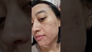 Laser Fractional CO2 di Klinik Surabaya [upl. by Jovitta]