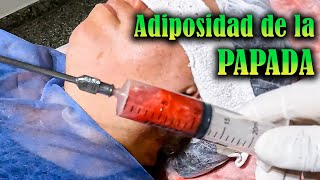 🔴 MINI LIPOSUCCIÓN en PAPADA  FUNCIONA 🤔 [upl. by Yelsew]