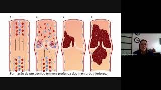 Patologia Geral  aula 8  Distúrbios da circulação  Trombose [upl. by Hoffer]