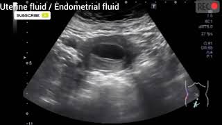 Uterine fluid I Endometrial fluid I Minimal fluid collection in uterine cavity [upl. by Atirehc]