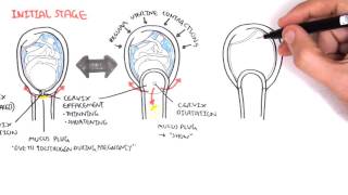 Abruptio Placentae vs Placenta Previa Nursing NCLEX Symptoms Causes Management Placental Abruption [upl. by Frederico920]