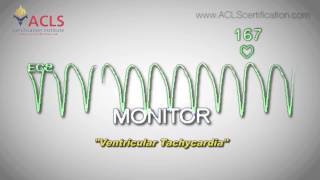 Ventricular Tachycardia by ACLS Certification Institute [upl. by Mandel]