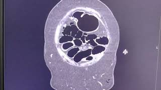 Small bowel obstruction  cause adhesions  search for the stenotic  transitional point [upl. by Sion]