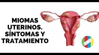 MIOMAS UTERINOS Síntomas y Tratamiento [upl. by Rosena916]