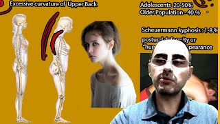 Kyphosis  Symptoms and causes and treatment [upl. by Chapel798]