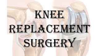 Watch This Before Your Knee Replacement Surgery [upl. by Ailecec]