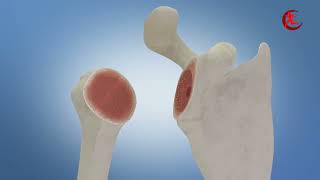 Reverse Shoulder Replacement animation english [upl. by Aneelad]