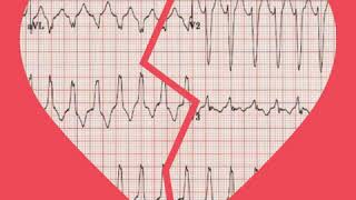 LVOT Obstruction case presentation [upl. by Marashio540]