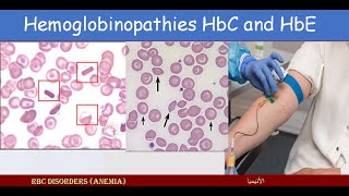 Lecture 284 Hemoglobinopathies HbC and HbE [upl. by Xyla269]