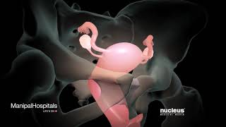 How Is A Robotic Hysterectomy Done  Robotic Hysterectomy Surgery  Gynaecology  Manipal Hospitals [upl. by Ninnetta]