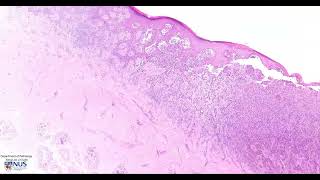 Skin Melanoma Microscopy  Talking slide [upl. by Atirehs]