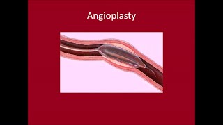 Angioplasty [upl. by Somerset]