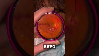 Branch Retinal Vein Occlusion eyes ophthalmology optometry [upl. by Na121]