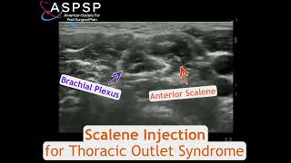 Scalene Injection for Thoracic Outlet Syndrome [upl. by Nissy]