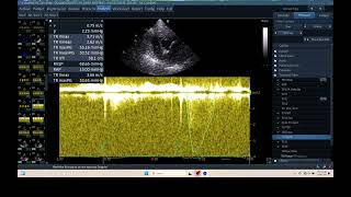 IQ 306 HEMODYNAMIC ECHOPAC ANALYSIS ECHOCARDIOGRAPHY HEPATOMA PTE [upl. by Sudnac]