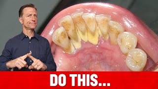 The 1 Top Remedy for Dental Plaque TARTAR [upl. by Monica]