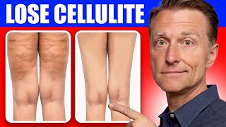 Get Rid of Cellulite for Good Dr Bergs Better Way to Lose Flabby Fat [upl. by Kori]