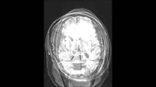 Primary CNS Lymphoma [upl. by Novehc446]